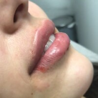 Aumento de labios relleno de labios bogota