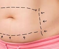 Abdominoplastia abdominoplastia bogota